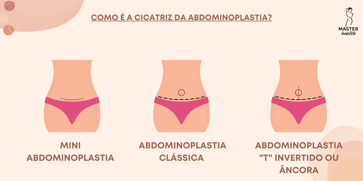 Abdominoplastia Dicas De Prepara O Para A Sua Cirurgia Blog Master