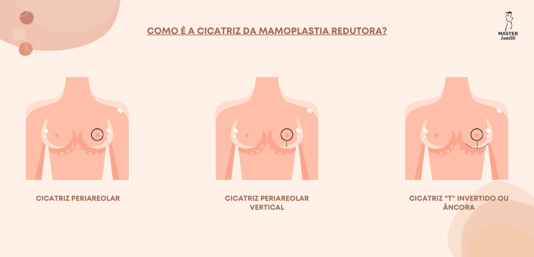 mamoplastia-redutora-protese-10-master-health