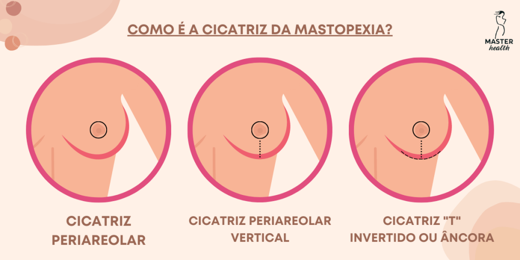 tipos-mamoplastia-05-master-health.