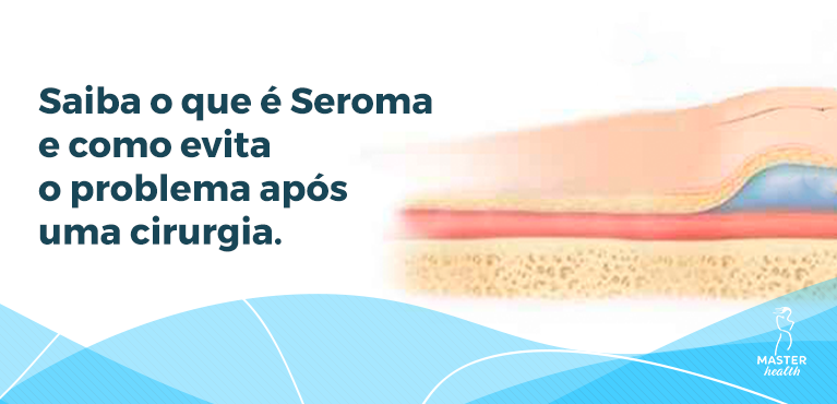 seroma