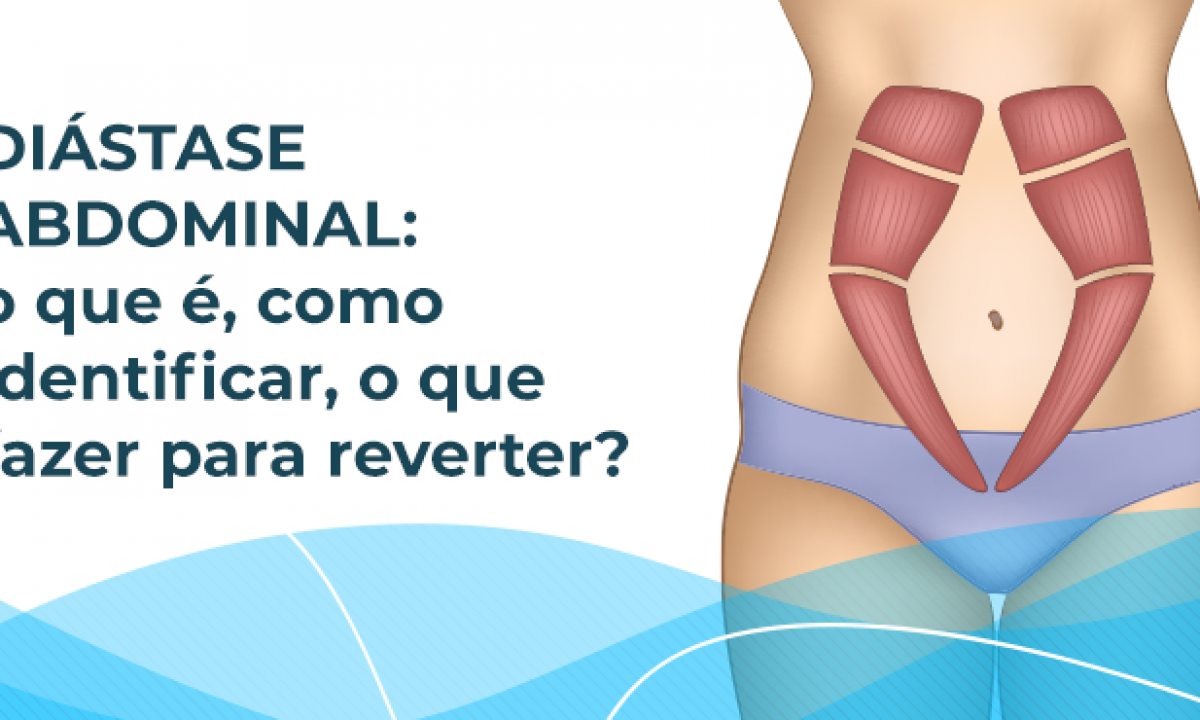 Diástase abdominal: como identificar e reverter? - Blog Master Health