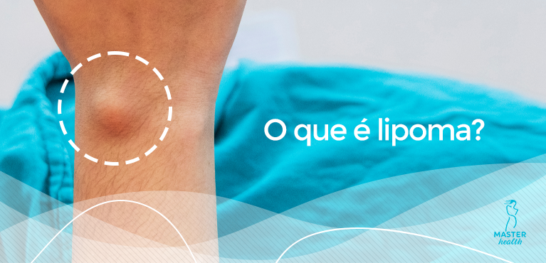 o que é lipoma