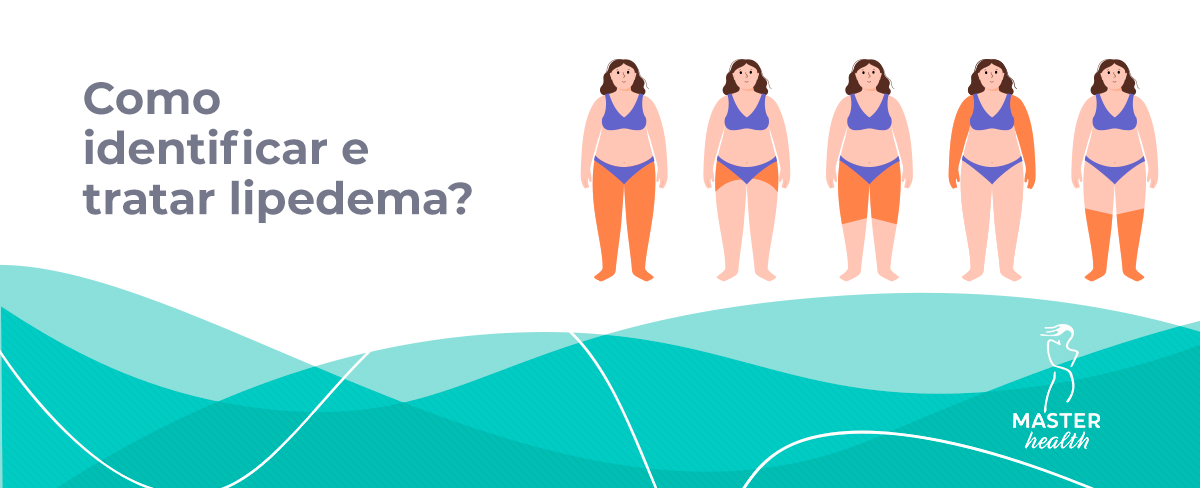 O lipedema é uma inflamação de baixo grau do tecido gorduroso