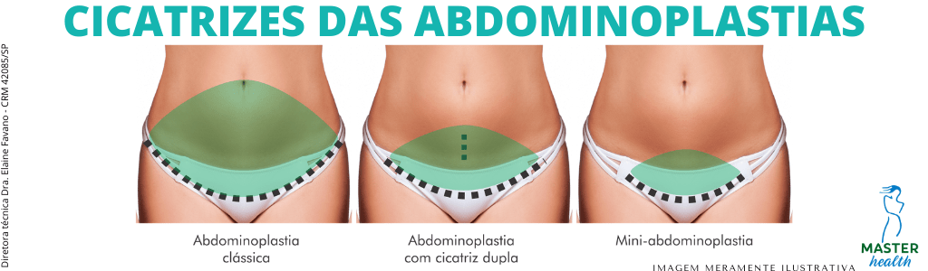 Abdominoplastia- O que é, Tipos e Cuidados